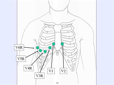 12 Lead Ecg Lead Placement Diagrams With Images