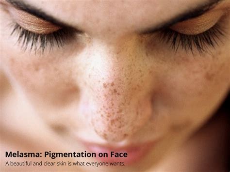 Melasma Pigmentation On Face