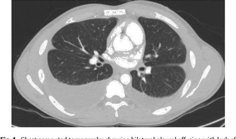 Figure 1 From Eosinophilic Pleural Effusion As A Manifestation Of