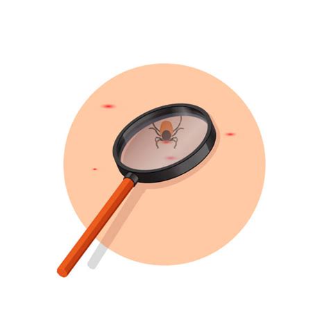 20 Removing Tick With Tweezers Stock Illustrations Royalty Free