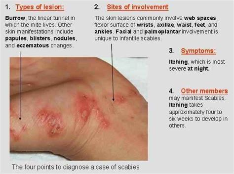 Scabies Infection The Mite Bite Dermatology Nurse Home Remedies