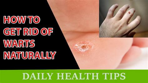 15 Home Remedies For Warts Easy Home Wart Treatments