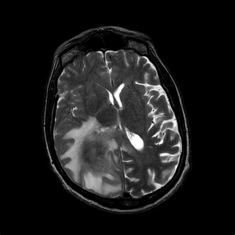 Primary Cns Lymphoma In Hivaids Patient Image