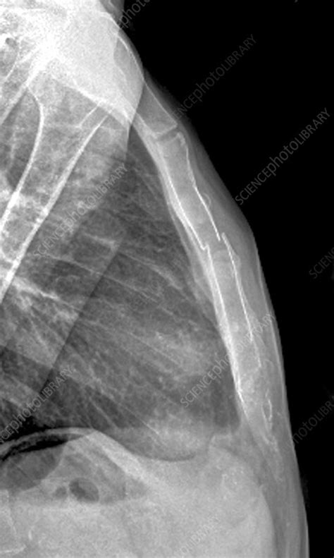 Fracture Of The Sternum X Ray Stock Image C0096805 Science Photo