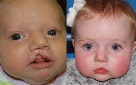 All You Need To Know About Cleft Lip And Cleft Palate Beauty Health Tips