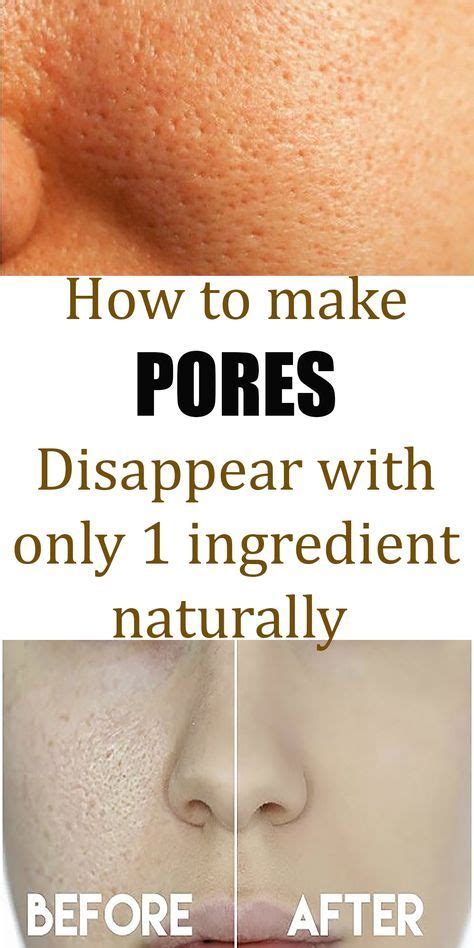 A Common Skin Problem In People With Oily Skin Is Large Pores Caused