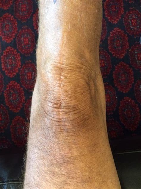 Two Years After Knee Replacement My Progress In 2021 Knee