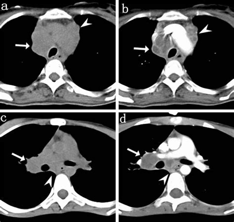 Enlarged Mediastinal Lymph Nodes With Peripheral Enhancement In Tb