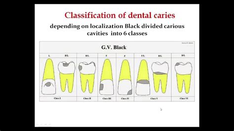 Classification Of Dental Caries Classes Of Caries Youtube