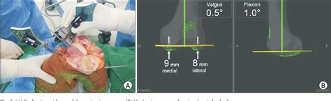 Figure 3 From The Accuracy Of Alignment Determined By Patient Specific