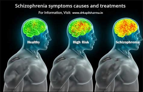 Schizophrenia Symptoms Causes And Treatments Dr Kapil Sharma Hot Sex