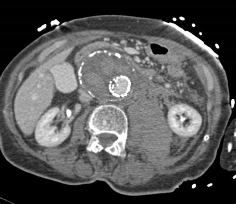 Retroperitoneal Bleed From A Leaking Aneurysm Vascular Case Studies