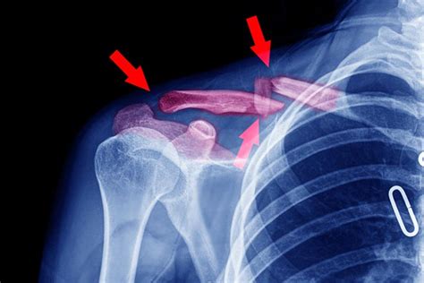 Broken Collarbone In Children Causes Symptoms And Treatment