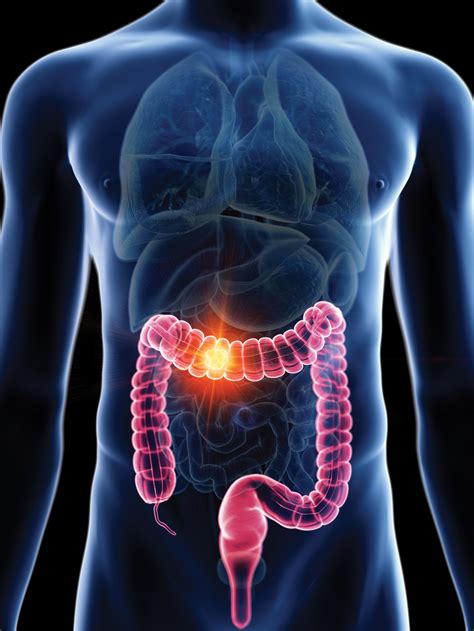 Rectal Cancer In S Early Detection Is Key To Treating Colon Cancer My