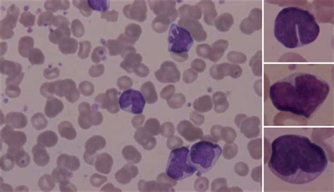 Lymphocytosis In A Baby With Pertussis The Lancet Infectious Diseases