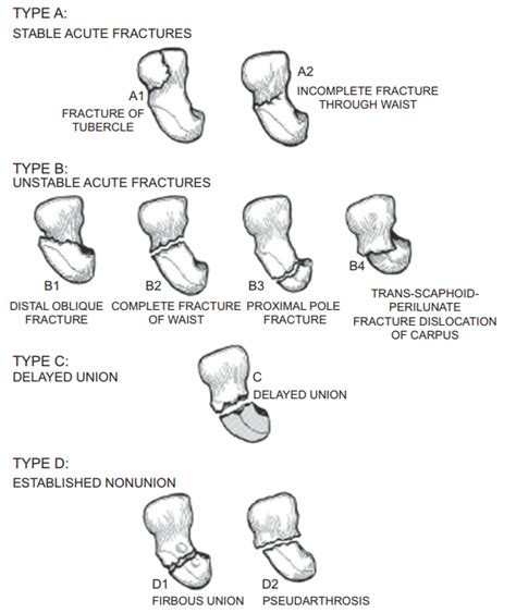 A Review On Reading Wrist X Rays Sports Medicine Review 2022