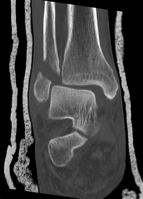 Ankle fracture - wikidoc