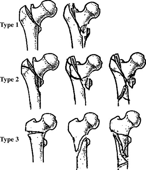 Three Types Of Extra Articular Proximal Femur Fracture Download Scientific Diagram