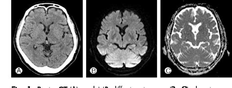 Figure 1 From Acute Spontaneous Cervical Epidural Hematoma Mimicking