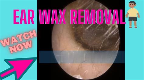 Severely Retracted Eardrum Ear Wax Removal Youtube