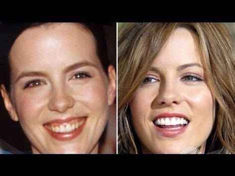 She began to age early, got wrinkles, flabby and sagging skin. Kate Beckinsale Plastic Surgery Before and After ...