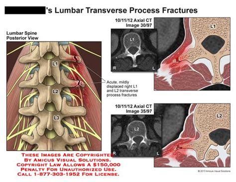 Transverse Process Fractures Of The Lumbar Spine