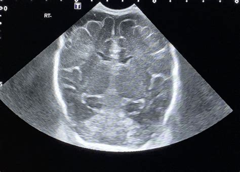 Introduction To Neonatal Cranial Ultrasound Paedshub