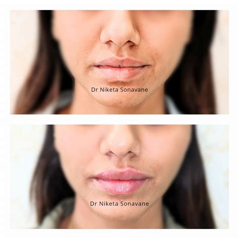 Lip Fillers In Mumbai Cost Before After Discount Lip Augmentation