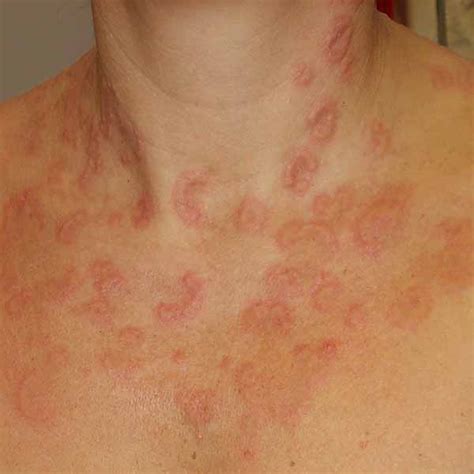 Fungal Infections On Skin Oberlinhealthcare