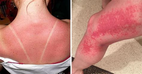 5 Signs Your Sunburn Is Actually Sun Poisoning
