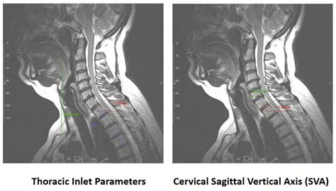 Figure 1 Thoracic Inlet Parameters And Cervical Sagittal Vertical Axis
