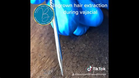 Ingrown Hair Extraction On Pubic Mound Youtube