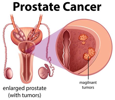 Tips To Prevent Prostate Cancer Health Saved