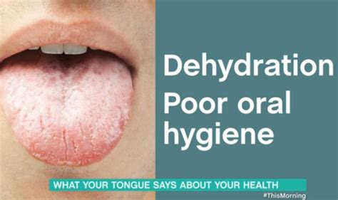 Dehydration Symptoms Tongue