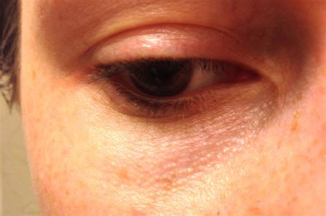 Skin Concerns Advice For My Thin Under Eye Skin Visible Oil Glands