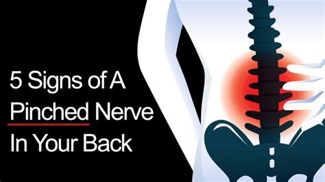 5 Signs Of A Pinched Nerve In Your Back Pinched Nerve Pinched Nerve