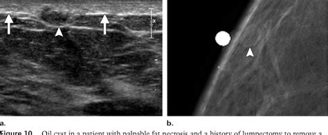 Figure 1 From Distinguishing Breast Skin Lesions From Superficial
