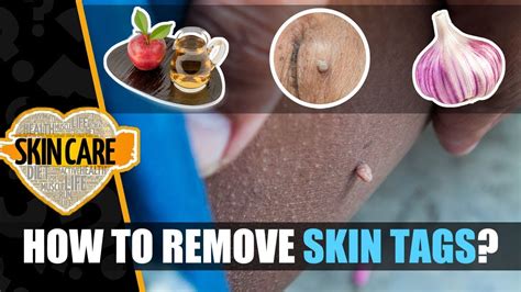 skin tag removal how to remove skin tags home remedies to remove skin tags youtube