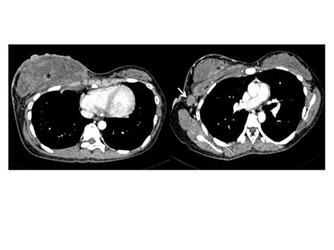 A Rare Case Of Primary Infiltrating Neuroendocrine Carcinoma Of The