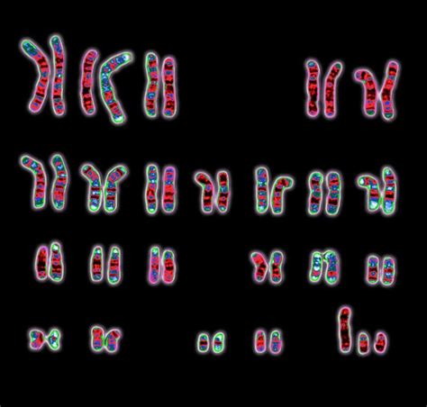 xyy syndrome karyotype 47 xyy wellcome collection
