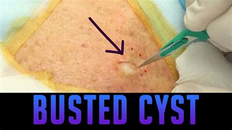 Excellent Epidermoid Cyst Excision Youtube