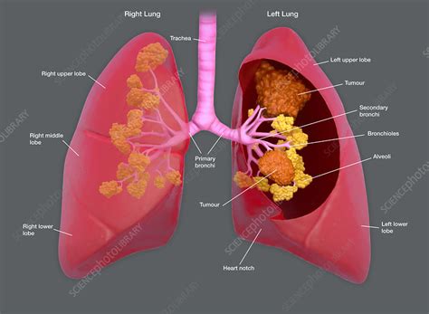 Lung Cancer Illustration Stock Image F0324738 Science Photo Library