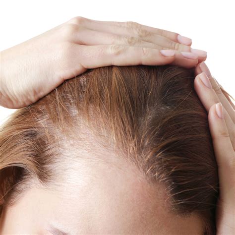Thinning Hair Causes Treatments And Prevention Human Hair Exim