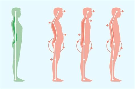 standing posture ormond physiotherapy