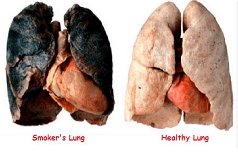 Identifying lung cancer at early stages is a strenuous task. EFFECTS OF SMOKING AND WHY YOU SHOULD QUIT. — Steemit