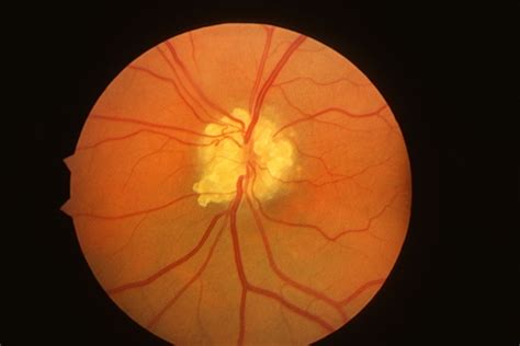 Optic Nerve Head Drusen Retina Image Bank
