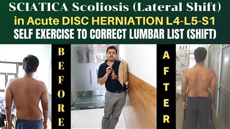 Sciatica Scoliosis Lumbar Disc Herniation L4 L5 S1 Lateral Shift