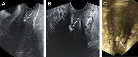Ultrasound Assessment Of The Intrauterine Device Obstetrics And