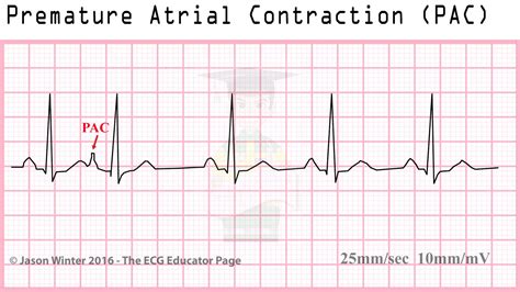 What Is The Treatment For Premature Ventricular Contractions