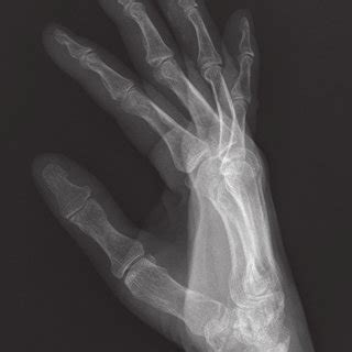 Pdf Acute Calcific Tendinitis In The Distal Interphalangeal Joint Hot Sex Picture